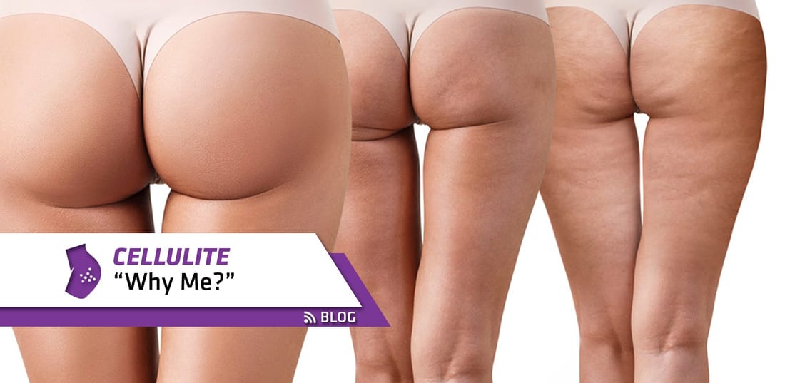 CELLULITE - WHY ME?